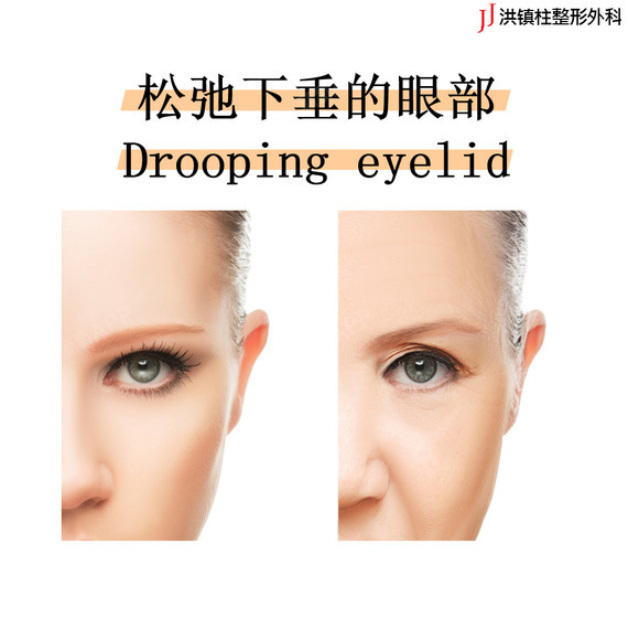 下垂的眼部 drooping eyelid 眼下松弛下垂