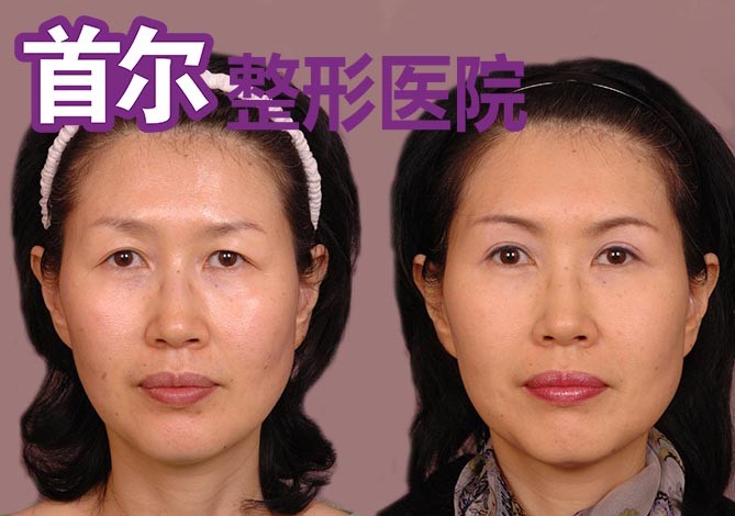 眼睑下垂,会造成眼角   眉毛提拉术分为眉上切除术和眉下切除术.