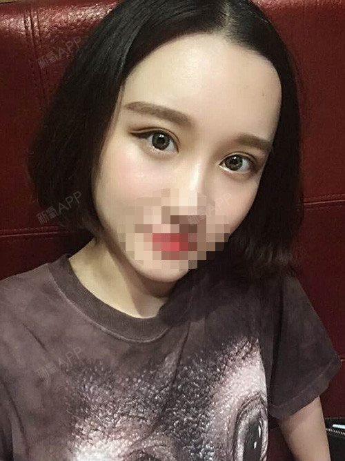 深圳福华医疗美容医院切开双眼皮第66天美丽