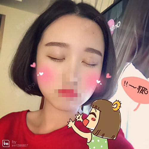 深圳福华医疗美容医院切开双眼皮第66天美丽