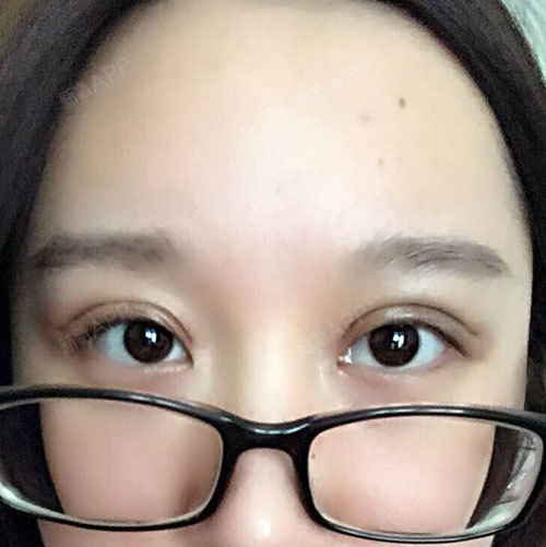 深圳福华医疗美容医院切开双眼皮第66天美丽