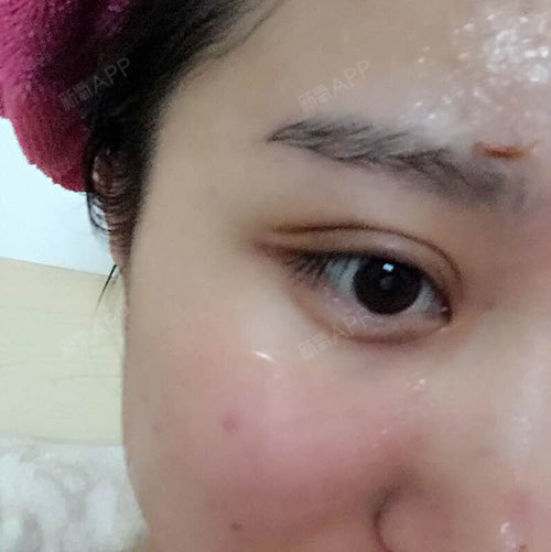 深圳福华医疗美容医院切开双眼皮第66天美丽