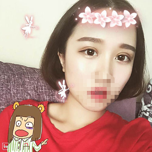 深圳福华医疗美容医院切开双眼皮第66天美丽