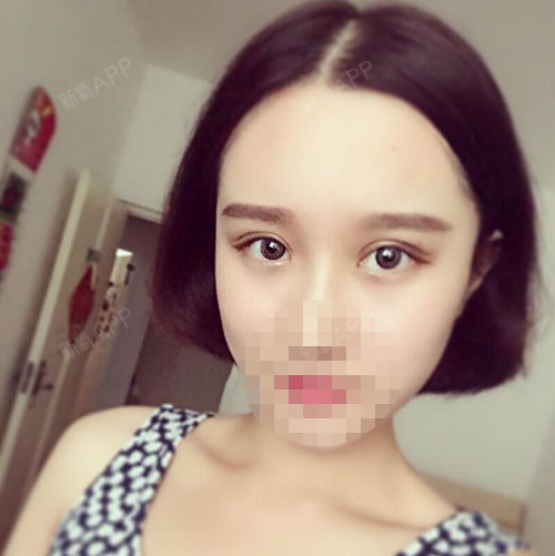 深圳福华医疗美容医院切开双眼皮第66天美丽