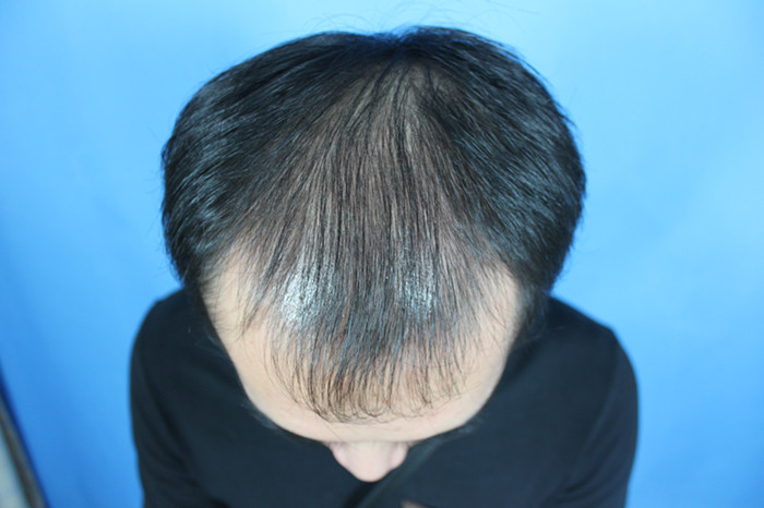现代九成以上的男性脱发均因雄性激素分泌失调导致,多