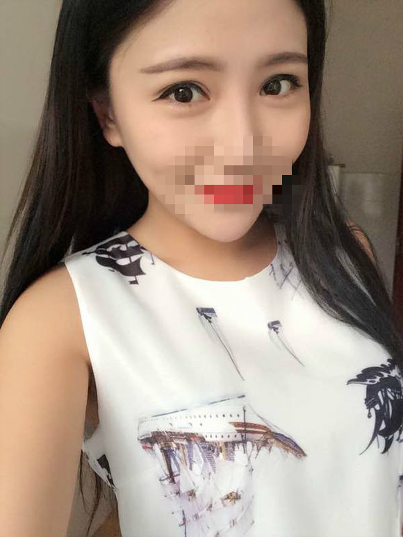 6 求美者:廖小姐 年龄:24岁 手术项目:韩式三点双眼皮