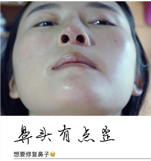 我女儿13岁,右侧胸部有大硬块,去医院检查医生说要手术才可确诊,这么