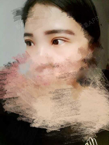 深圳福华医疗美容医院定点双眼皮第25天美丽