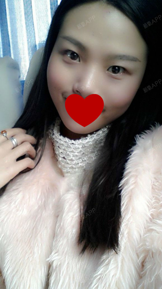 深圳福华医疗美容医院切开双眼皮第287天美丽