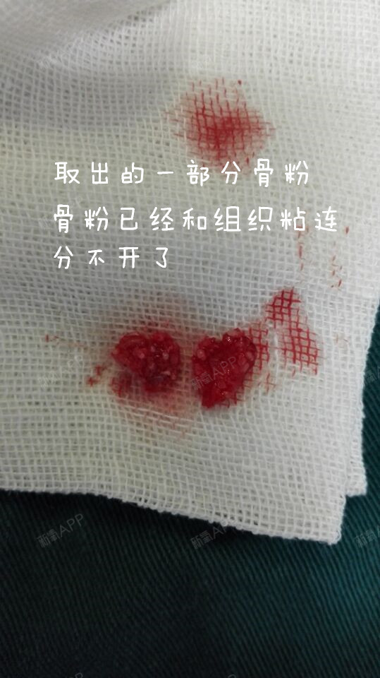 多年前骨粉隆鼻,后来鼻子就成这样了,去了很多医院都不敢做,骨粉很难