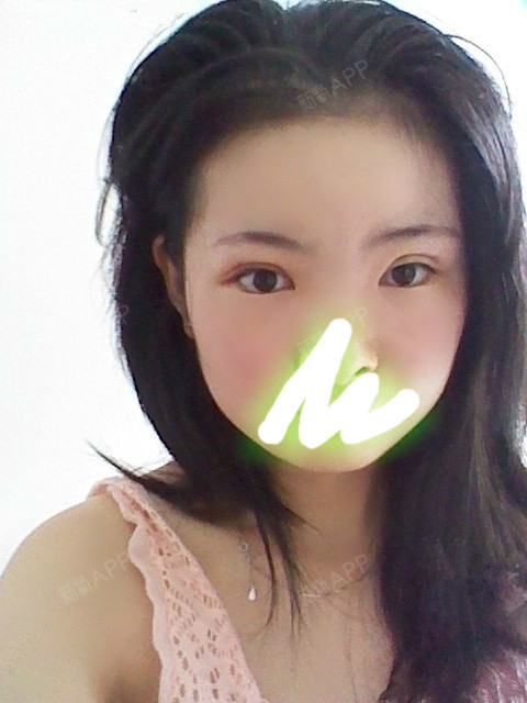 深圳福华医疗美容医院开双眼皮第17天美丽日