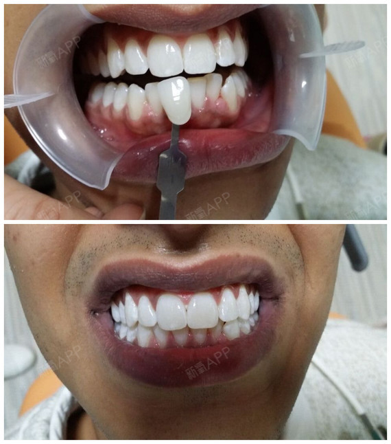 【牙齿美白】冷光美白爱护牙齿,关爱健康,科雅口腔与您