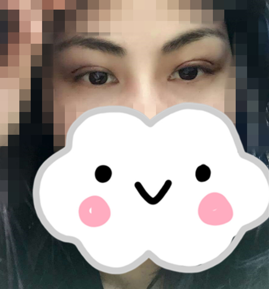 手术后一周,眼睛还有点肿胀,但是和他们切开的比的我已经是很满足啦