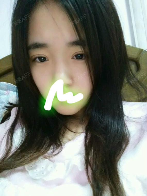 深圳福华医疗美容医院定点双眼皮第8天美丽日