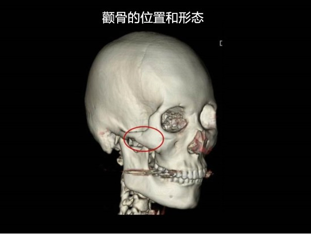 想要缩小侧颧骨一定要先正确的理解担当侧颧骨轮廓的骨头的解剖学