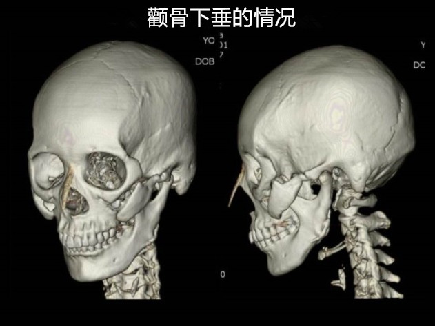 拉菲安整形外科# #郑院长讲解# 缩小侧颧骨的有效手术方法