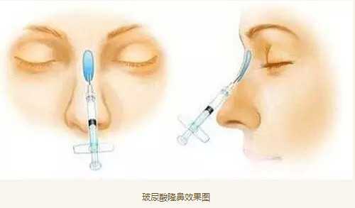 假体隆鼻 到底该用硅胶还是膨体?新氧专访大连爱德丽格 张晨