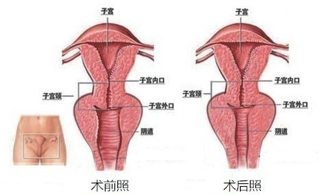 【私密整形】自体多维分层激光技术 私处抗衰紧致