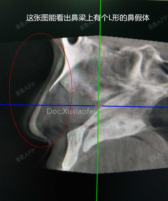 ct里的真实——鼻中隔检查.最近妹子们的问题越来越