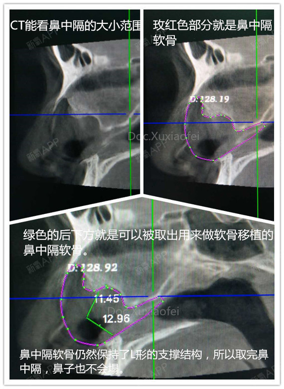 ct里的真实——鼻中隔检查.最近妹子们的问题越来越