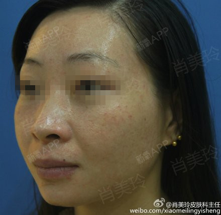 #激素依赖性皮炎#帅小姐来院复诊,已治疗47天