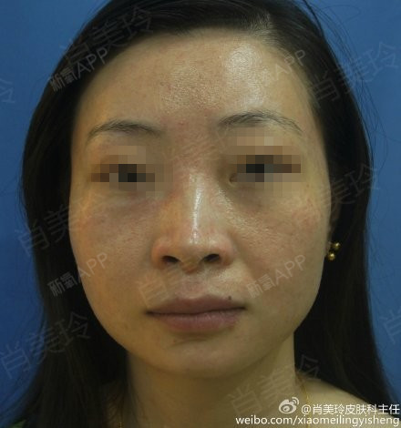 #激素依赖性皮炎#帅小姐来院复诊,已治疗47天