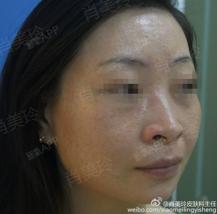 #激素依赖性皮炎#帅小姐来院复诊,已治疗47天