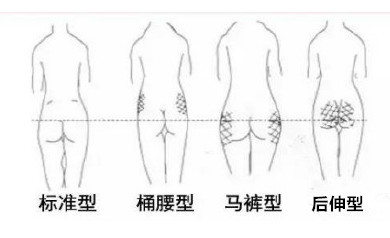 后伸型:臀部脂肪在臀裂两端,臀部向后伸展.