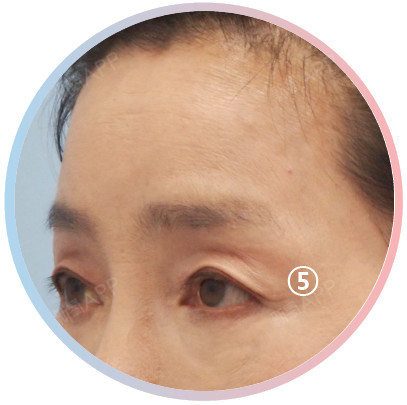 LaBomPLASTICSURGERY本月的案例内窥镜