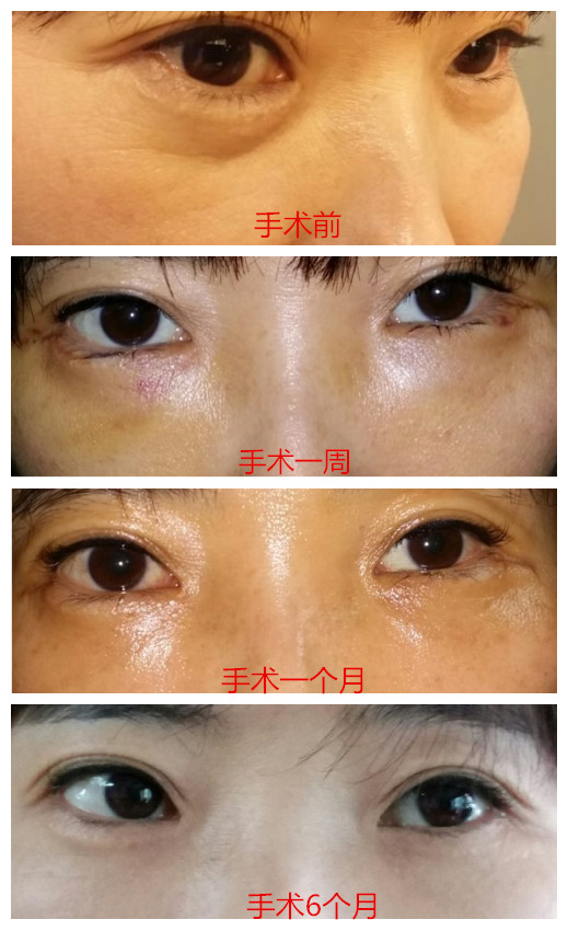 以上的照片就是进行了韩国下眼睑手术改善了眼下肌肤松弛状况的案例