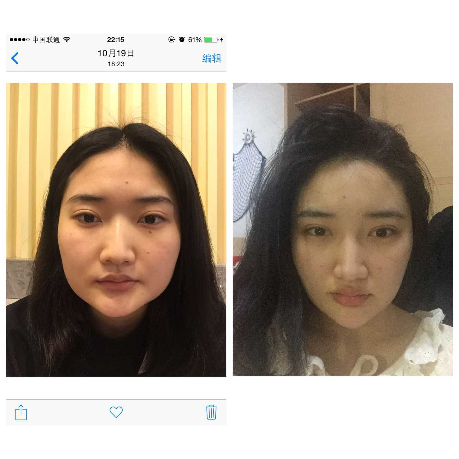 自体脂肪丰额头怎么样_恢复过程_效果如何_不是缪斯10