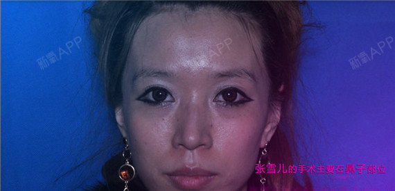 【扒皮】成都Angelababy背后的故事手术前,无