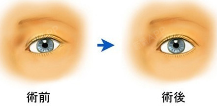 网络上风靡的芭比眼,受到一大批爱美女性的追崇~网红范儿,混血感是最受欢迎_圈子-新氧美容整形