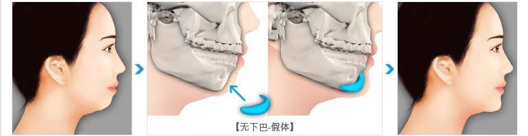 清潭优整形知识/硅胶假体隆下巴有哪些注意事项?