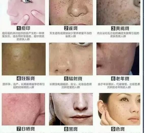 温柔告别黄褐斑-下"斑"快乐!