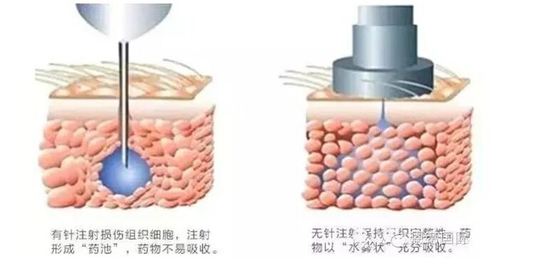 有针水光和无针水光的注射原理对比