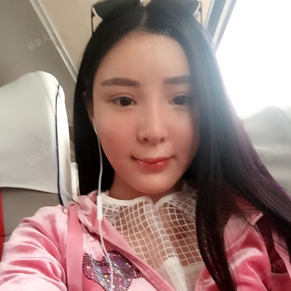 南通美莱整形美容医院下颌角整形术第13天美
