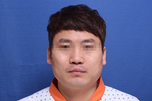 术前状况也就是这样的,唇部形状不规律,先天性唇裂