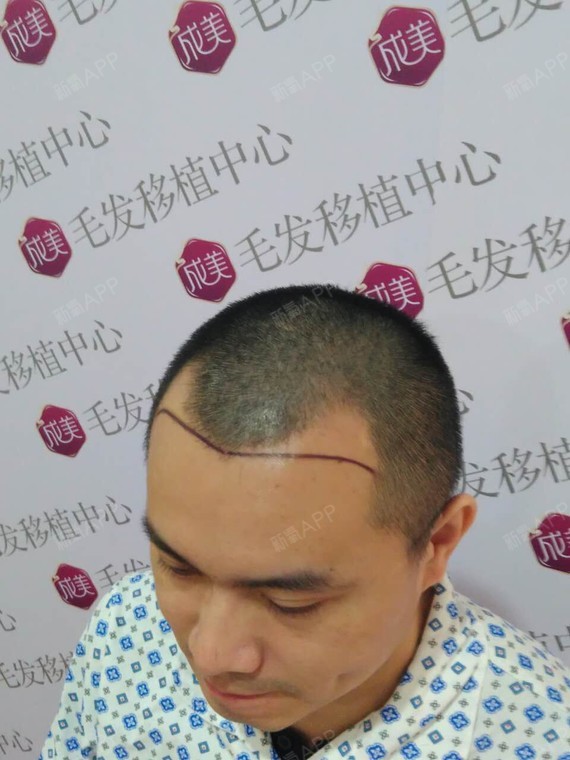 种植鬓角