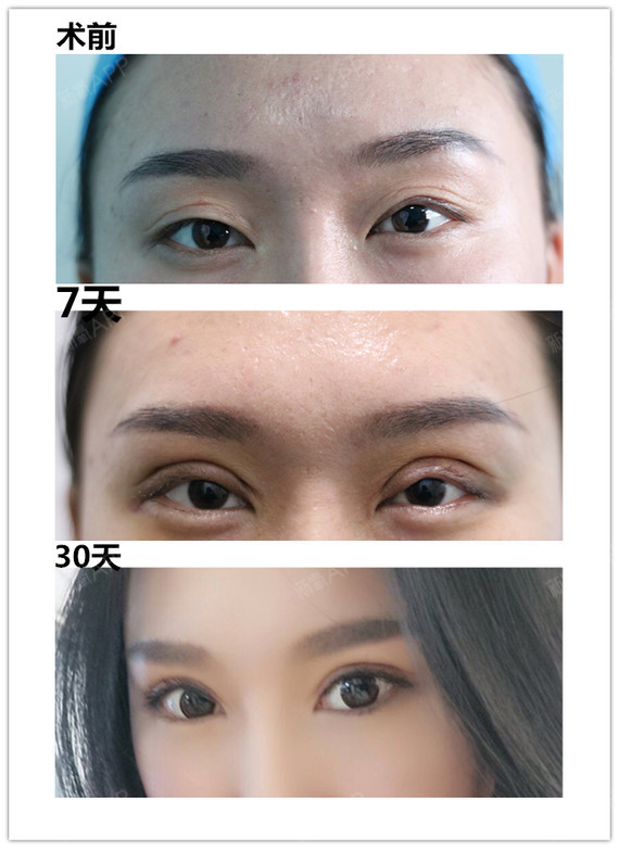 全切双眼皮还能用韩式三点修复?美眼再现给你最直观的