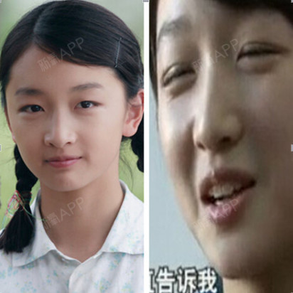 为什么有些人割过双眼皮后,反而越来越丑
