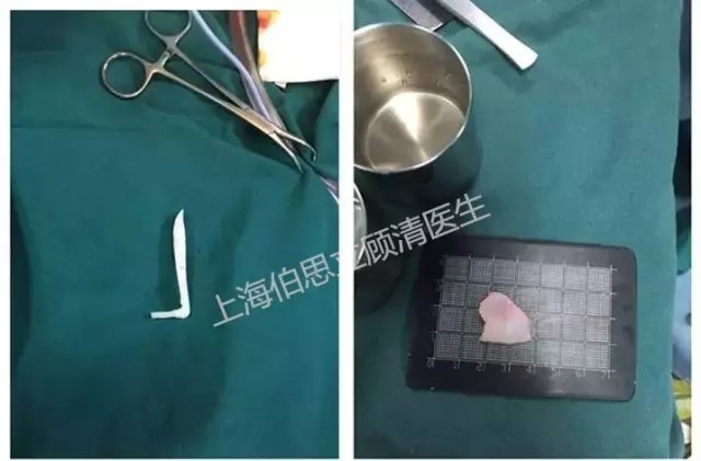 取出的假体及鼻中隔软骨        现在让我们来看看经过一周