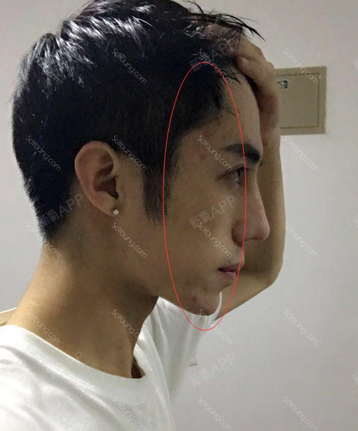 刘泽雨水光针第63天美丽日记-新氧美容整形