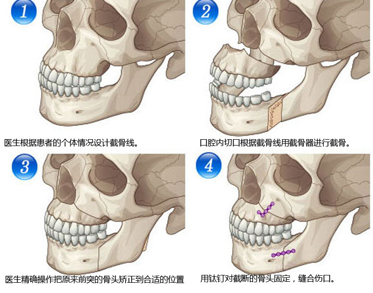 是针对由于颌面骨骼畸形导致的上颌/下颌突出,咬合关系不良的矫正手术