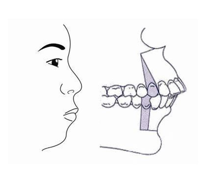b上下颌左右第四牙齿拔除,上颌前份截骨 下颌根尖下截骨
