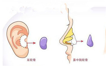 【自体耳软骨 硅胶隆鼻】征集案例发日记返现 打造自然挺翘美鼻