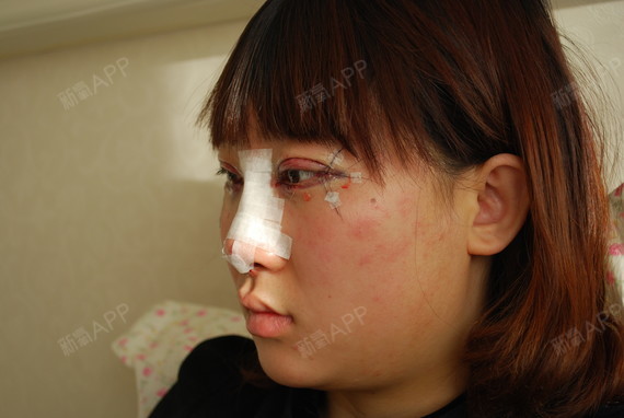 青岛伊美尔国宾整形外科医院切开双眼皮第15