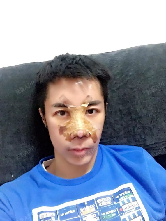 刘泽雨鼻部修复第32天美丽日记-新氧美容整形