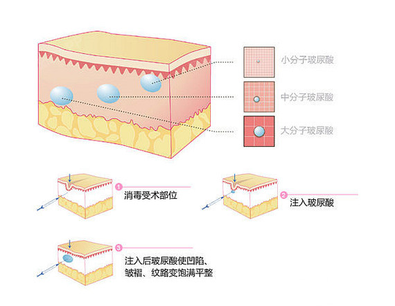 【看完这篇文章,才算真正了解玻尿酸】