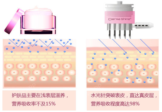 补水只是水光针最基本的作用,比如说我们在水光针里加入肉毒素会达到